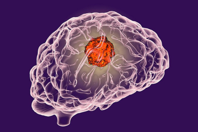Ученые нашли лекарство от рака мозга | FED.az