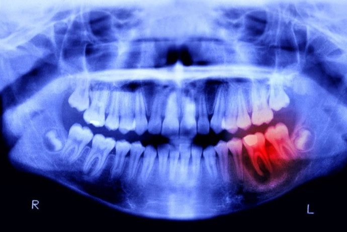 10 milyard dollarlıq implant bazarını bağlayacaq yenilik: Dişləri yenidən çıxaran dərman tapılıb | FED.az