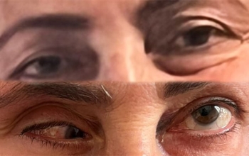 Bu klinika təzminat ödəyəcək - Burun düzəldəndə gözü zədələyib - FOTO | FED.az