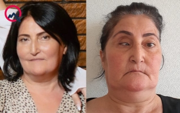 Bu klinika təzminat ödəyəcək - Burun düzəldəndə gözü zədələyib - FOTO | FED.az